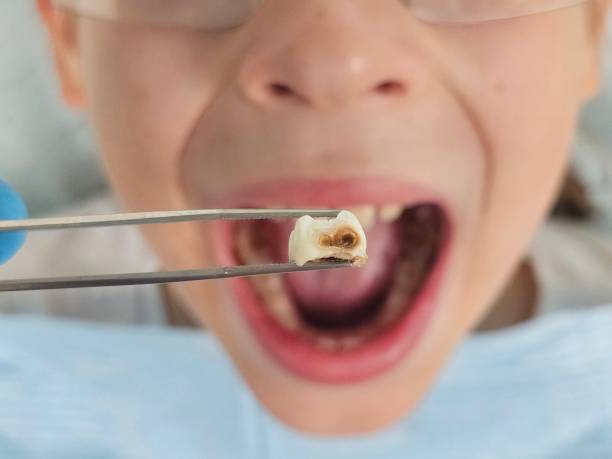 Best Emergency Tooth Extraction in Tyler, MN